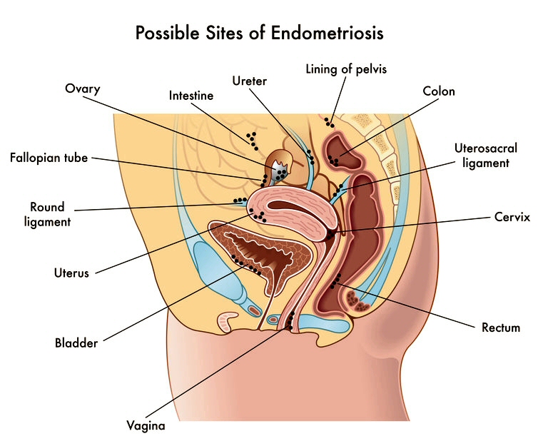 Endometriosis - Sites in the Body