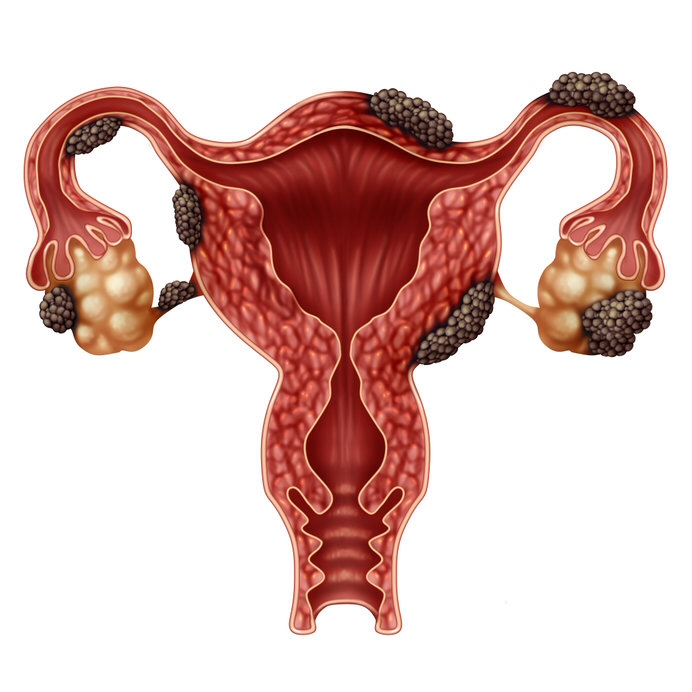 Endometriosis around the Uterus