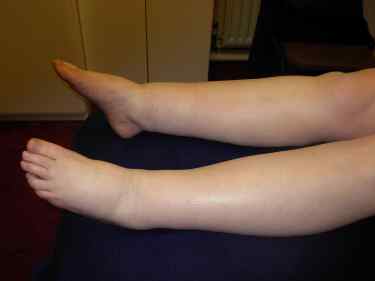 Lymphoedema. Lymphedema. Lymphatic drainage massage. Swollen legs