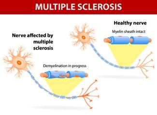 The effect of nerve damage in Multiple Sclerosis (MS)